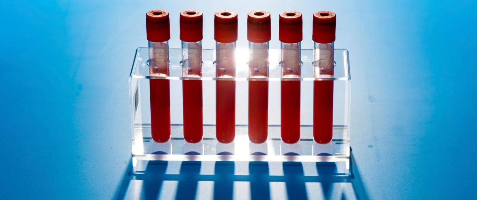 Targeted child leukaemia therapy Six red-topped test-tubes in a rack each filled with blood